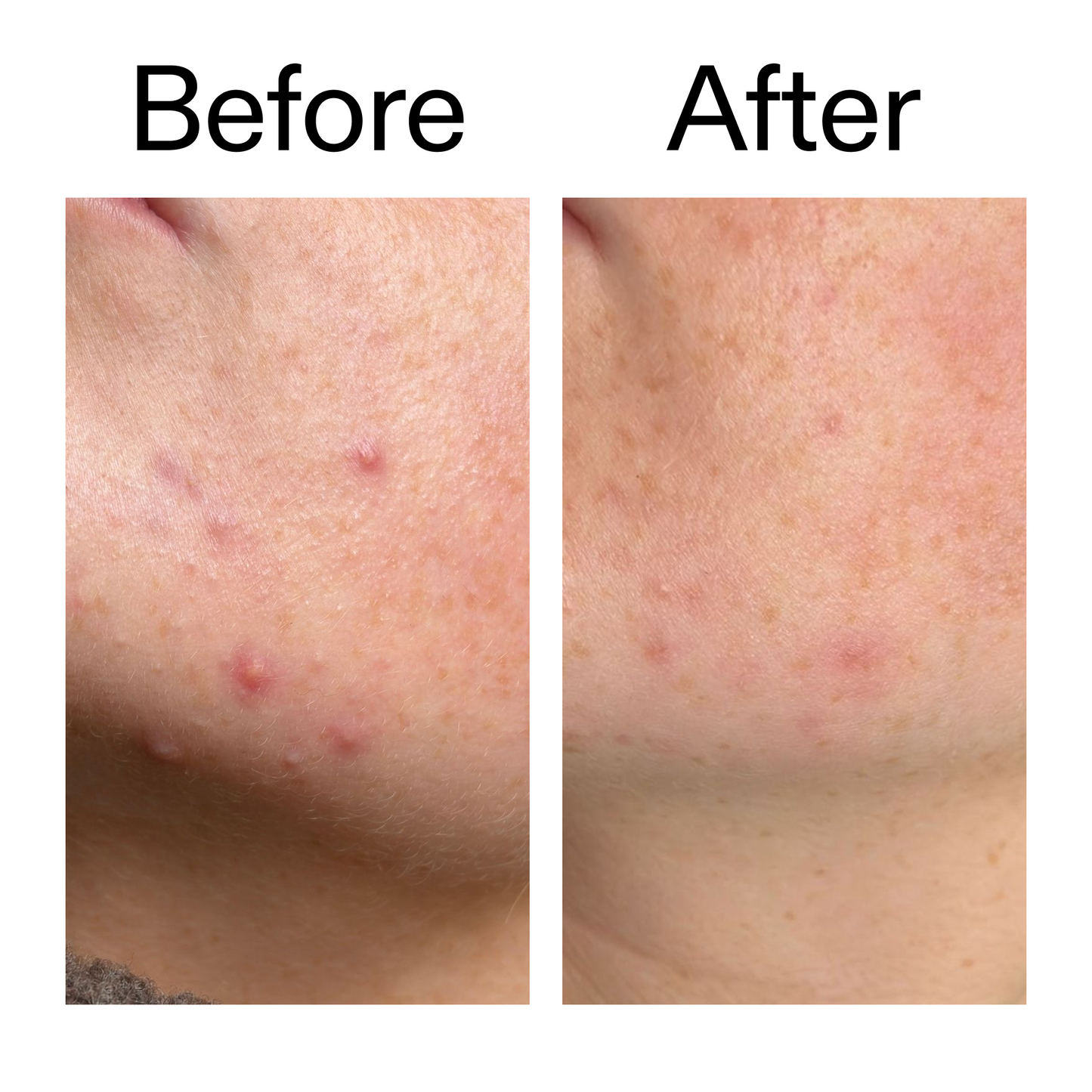 10-azelaic-acid-serum-for-redness-relief-l7 B_A_1_PPAGE.png