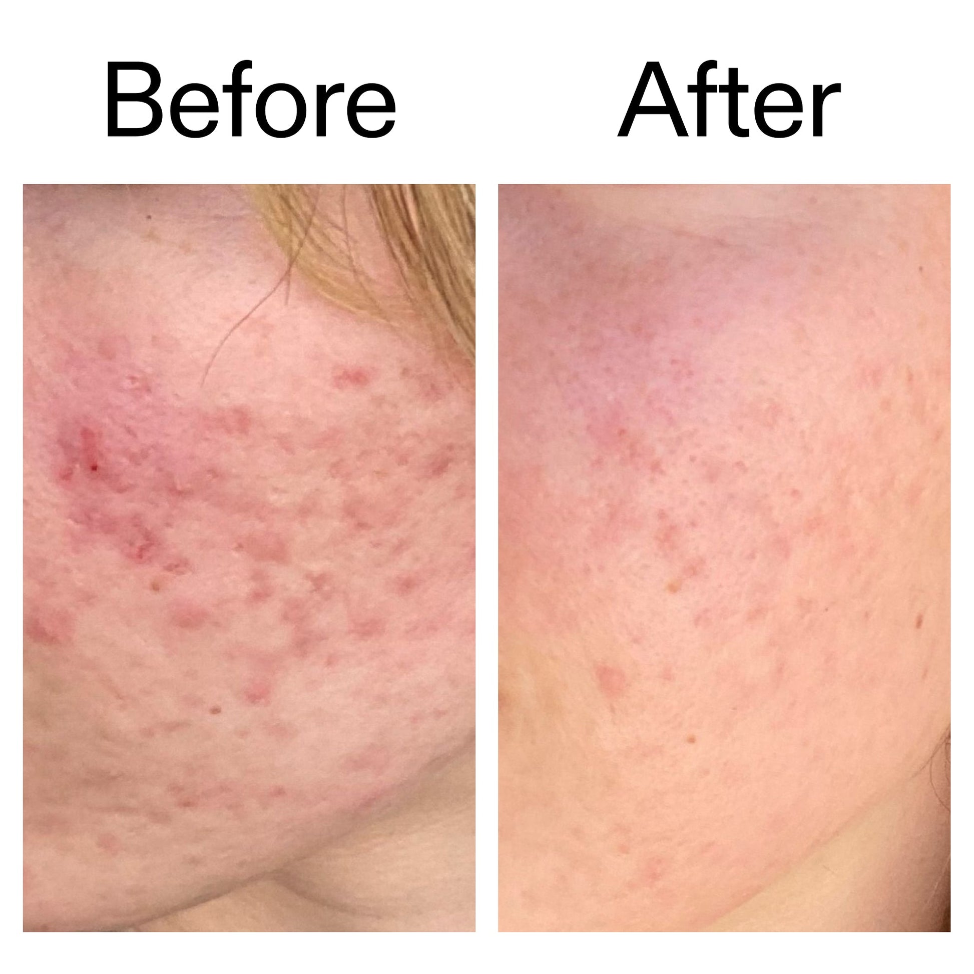 10-azelaic-acid-serum-for-redness-relief-l7 Azealic_Acid_Serum_B_A_Ppage_2000_x_2000.jpg