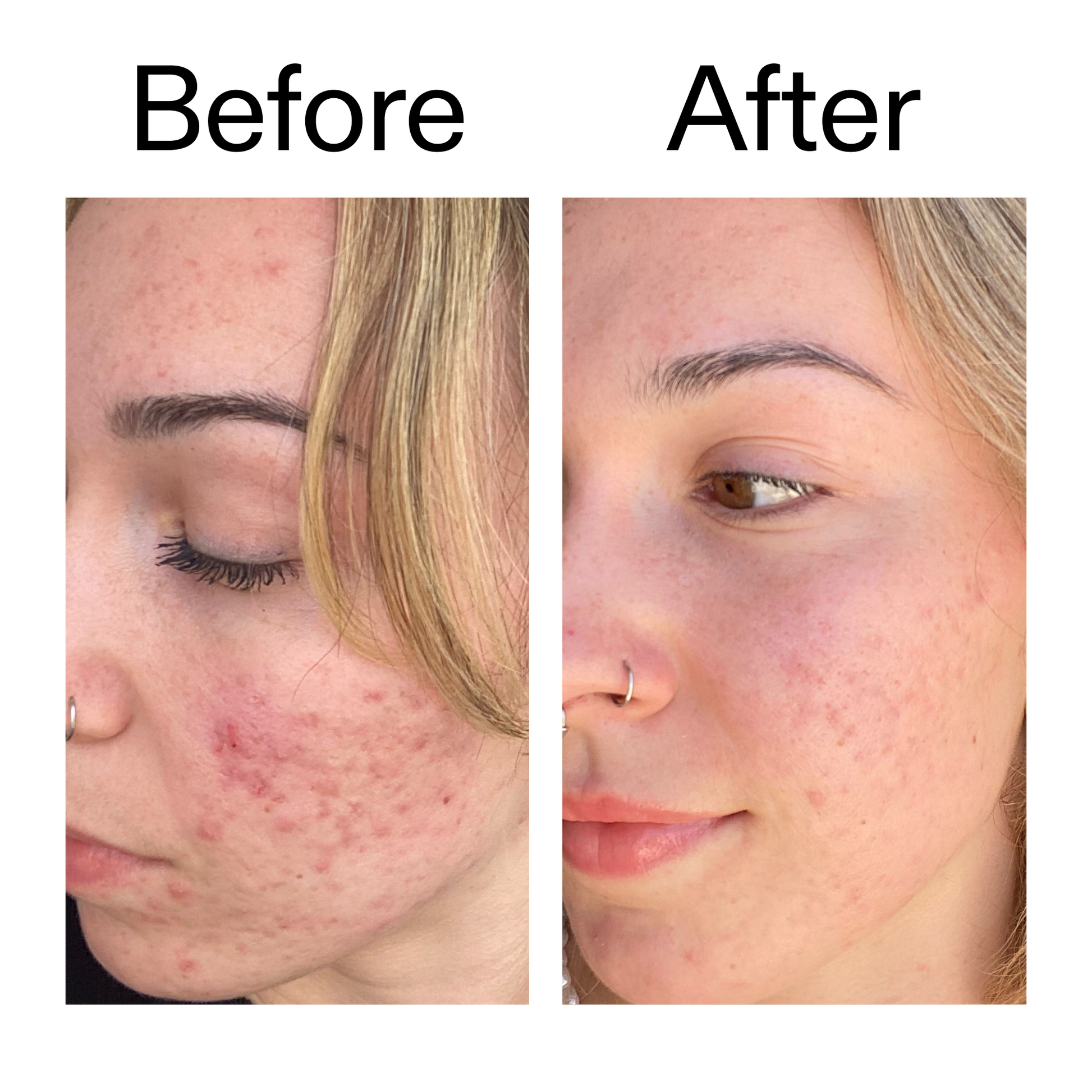 10-azelaic-acid-serum-for-redness-relief-l7 B_A_2_PPAGE.png