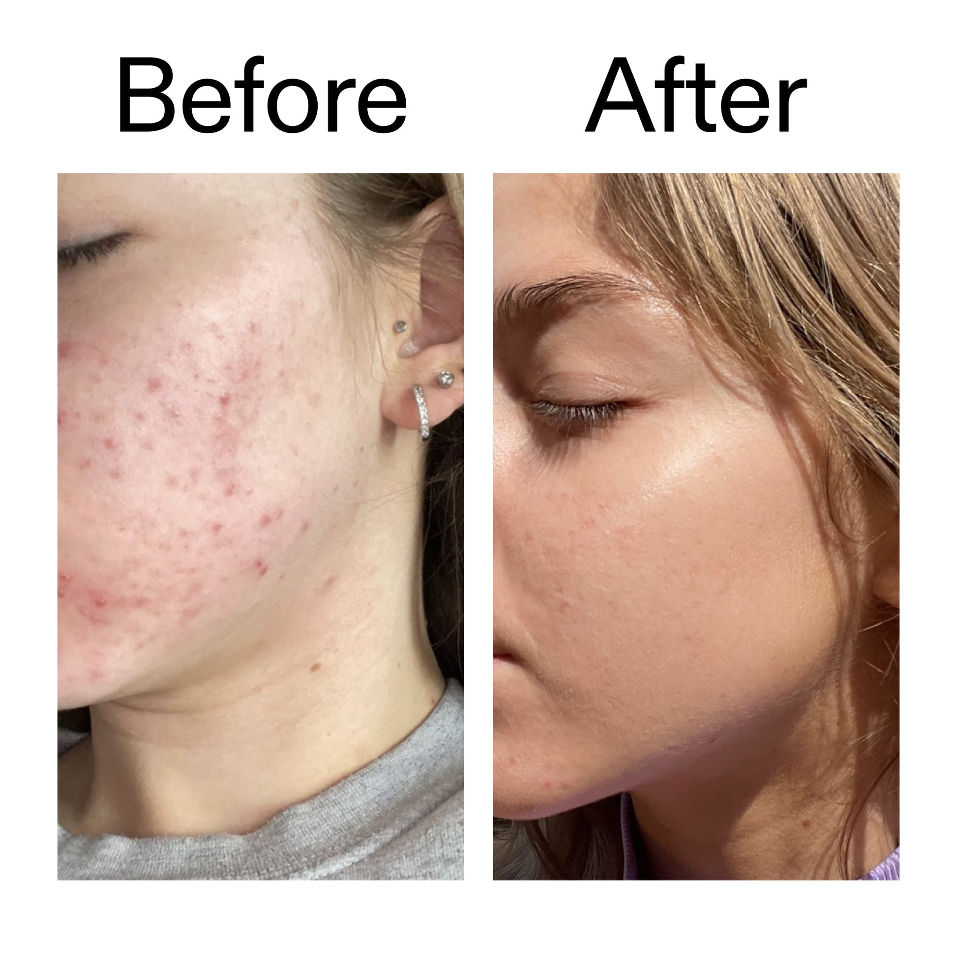 beta-hydroxy-acid-bha-serum-y9 Beta_Hydroxy_Acid_Serum_Before_After_2000x2000_96fda3e5-938d-49ef-bcf2-a0fa6ece4e2c.jpg