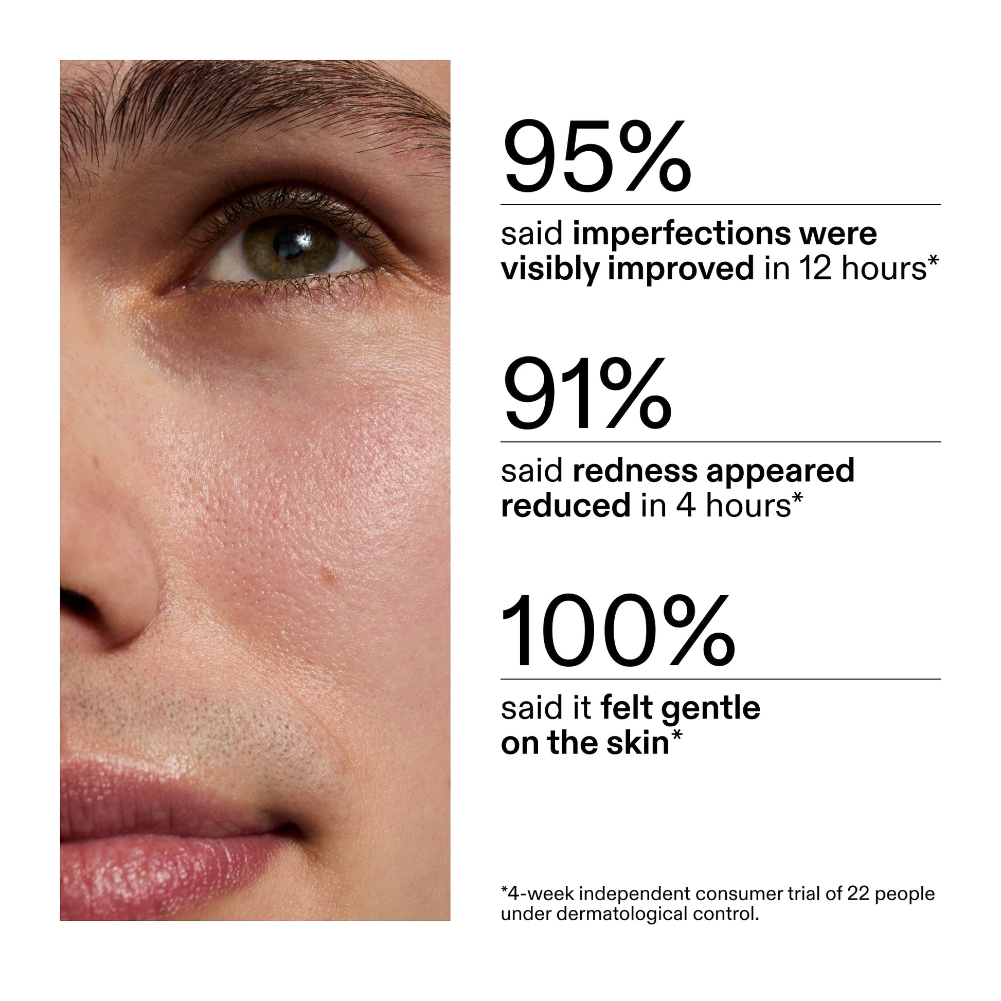 succinic-acid-acne-treatment-t7 CA_Succinic_Acid_Treatment_key_Claims_2000x2000_db91b0f1-7f29-4bfe-bb16-63a47f500960.jpg