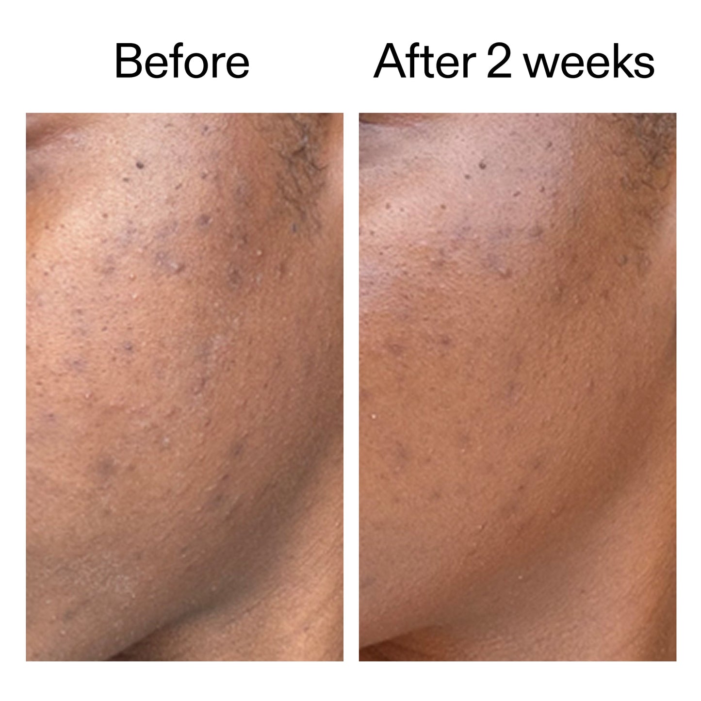 360-acne-clearing-duo-y6 DIOICB_A2000x2000.jpg