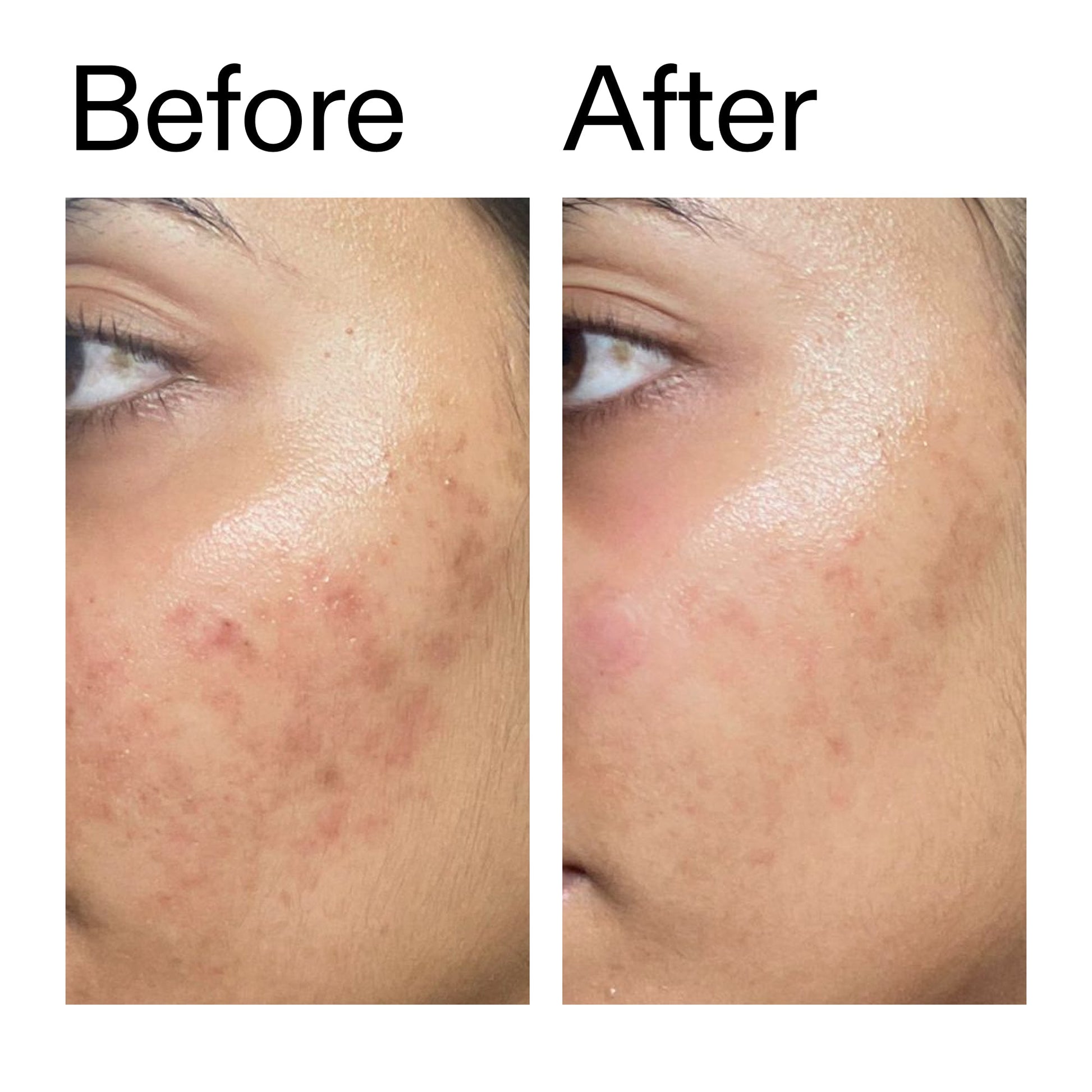 ectoin-hydro-barrier-serum-j5 Ectoin_Hydro-barrier_Serum__Before_After_2000x2000_34261920-d004-48d0-9c7b-8e1c15971bfd.jpg
