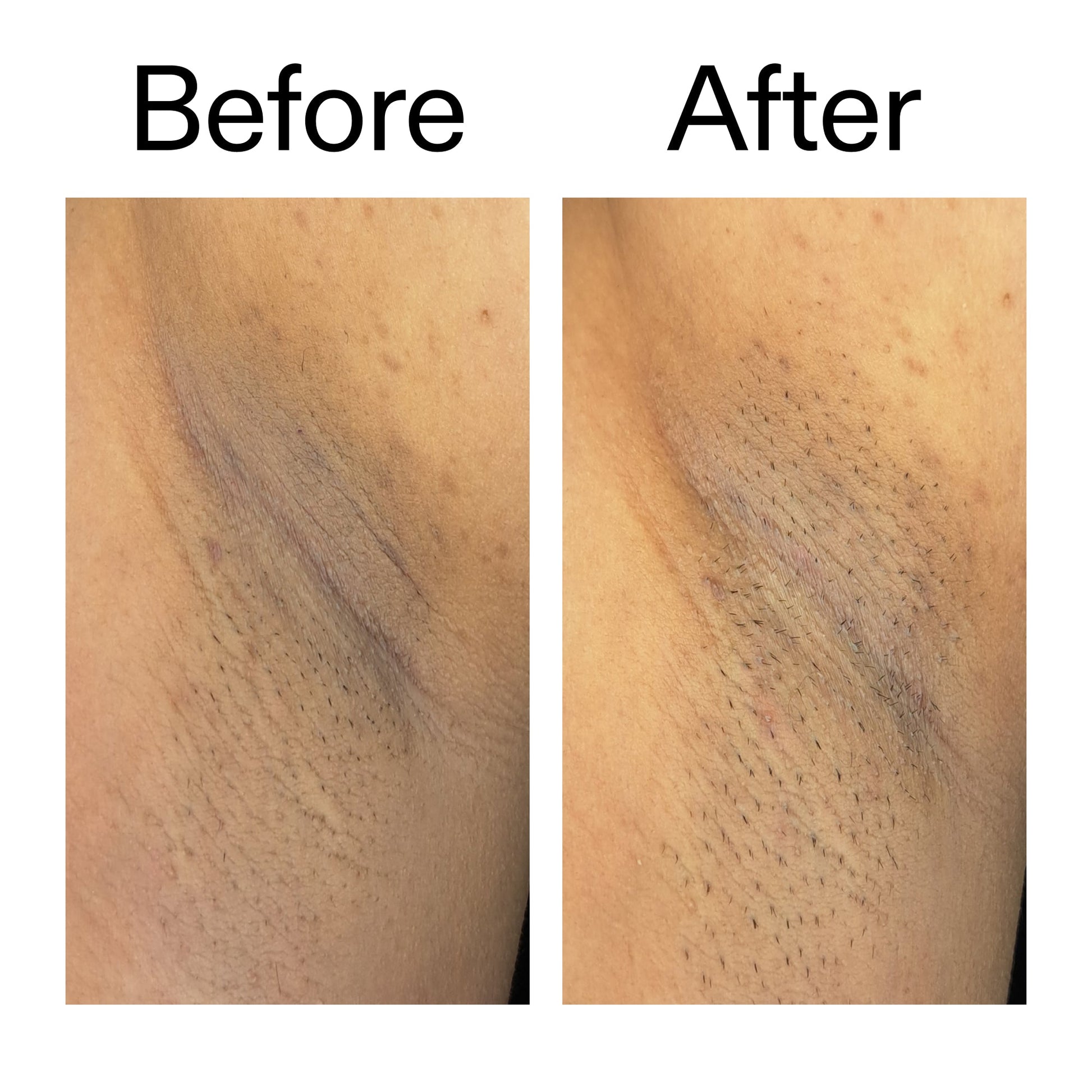 glycolic-acid-exfoliating-body-stick-j7 Glycolic_Acid_Exfoliating_Body_Stick_Before_After_V3_2000x2000_ea919cd9-1439-4a46-82a0-76200eb5bb42.jpg