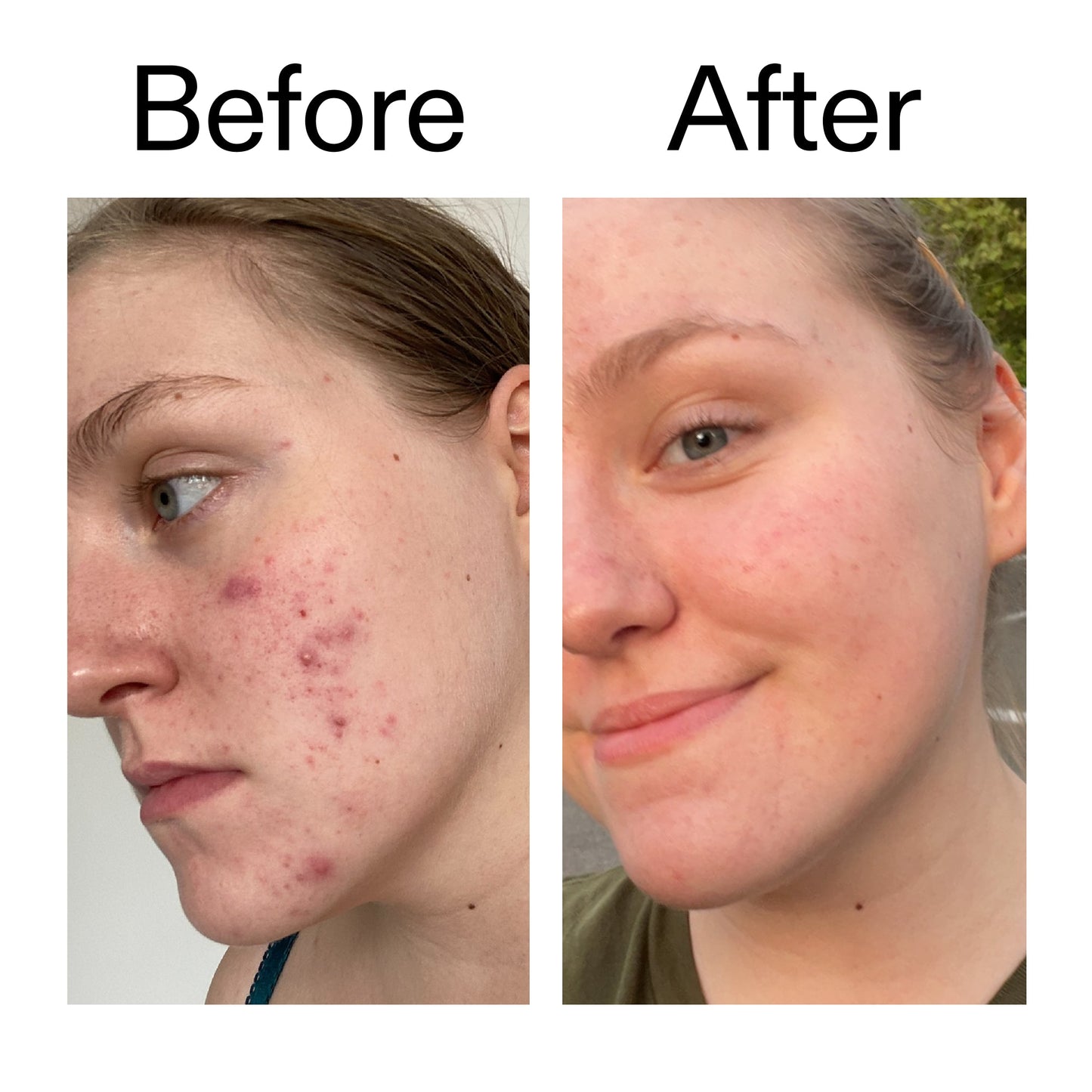 glycolic-acid-toner-a5 Glycolic_Acid_Toner_Before_After_2000x2000_49f0b9f7-e71b-4b2e-a8f8-2ea4b73247bb.jpg