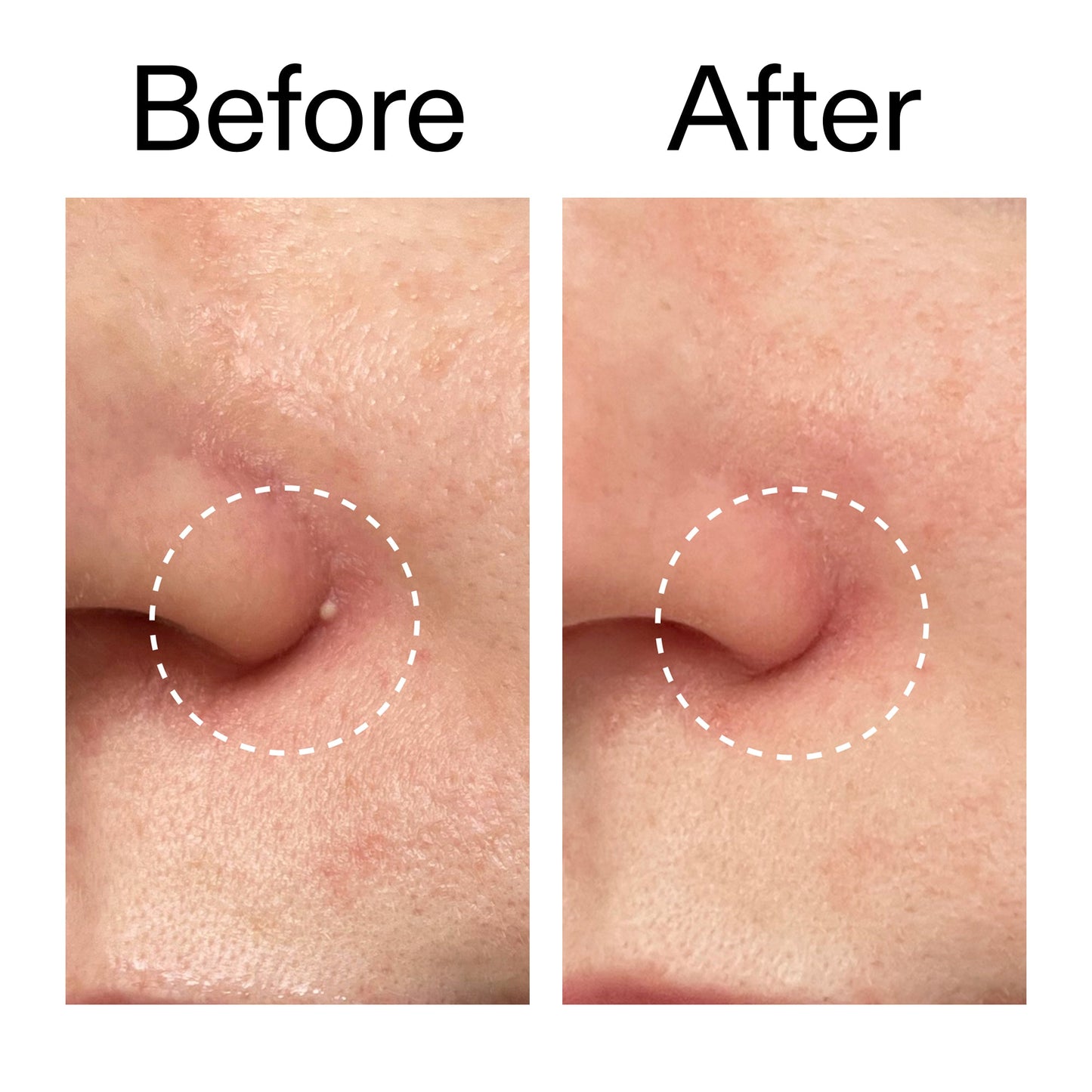 hydrocolloid-invisible-pimple-patches-pack-of-22-c8 Hydrocolloid_Invisible_Pimple_Patches_Before_After_2000x2000_b02aa37b-c78a-4682-91de-9135af5bb7df.jpg