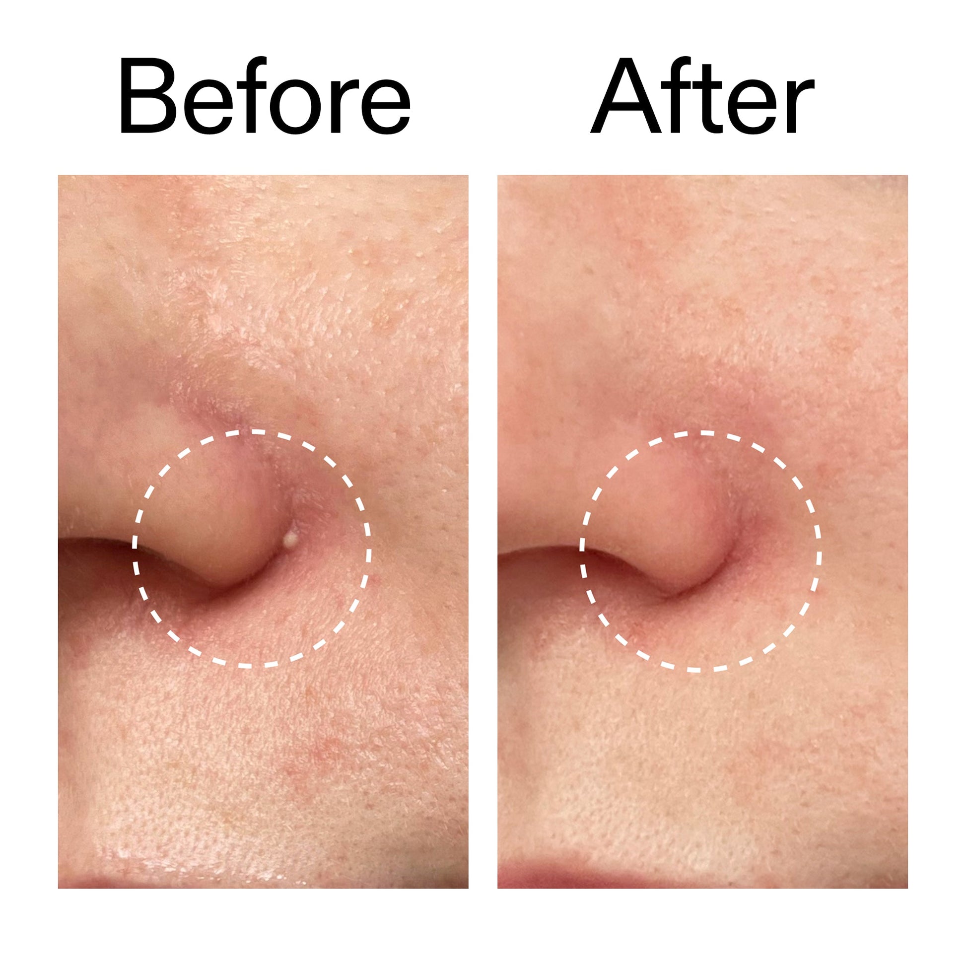 hydrocolloid-invisible-pimple-patches-pack-of-44-a7 Hydrocolloid_Invisible_Pimple_Patches_Before_After_2000x2000_b02aa37b-c78a-4682-91de-9135af5bb7df.jpg