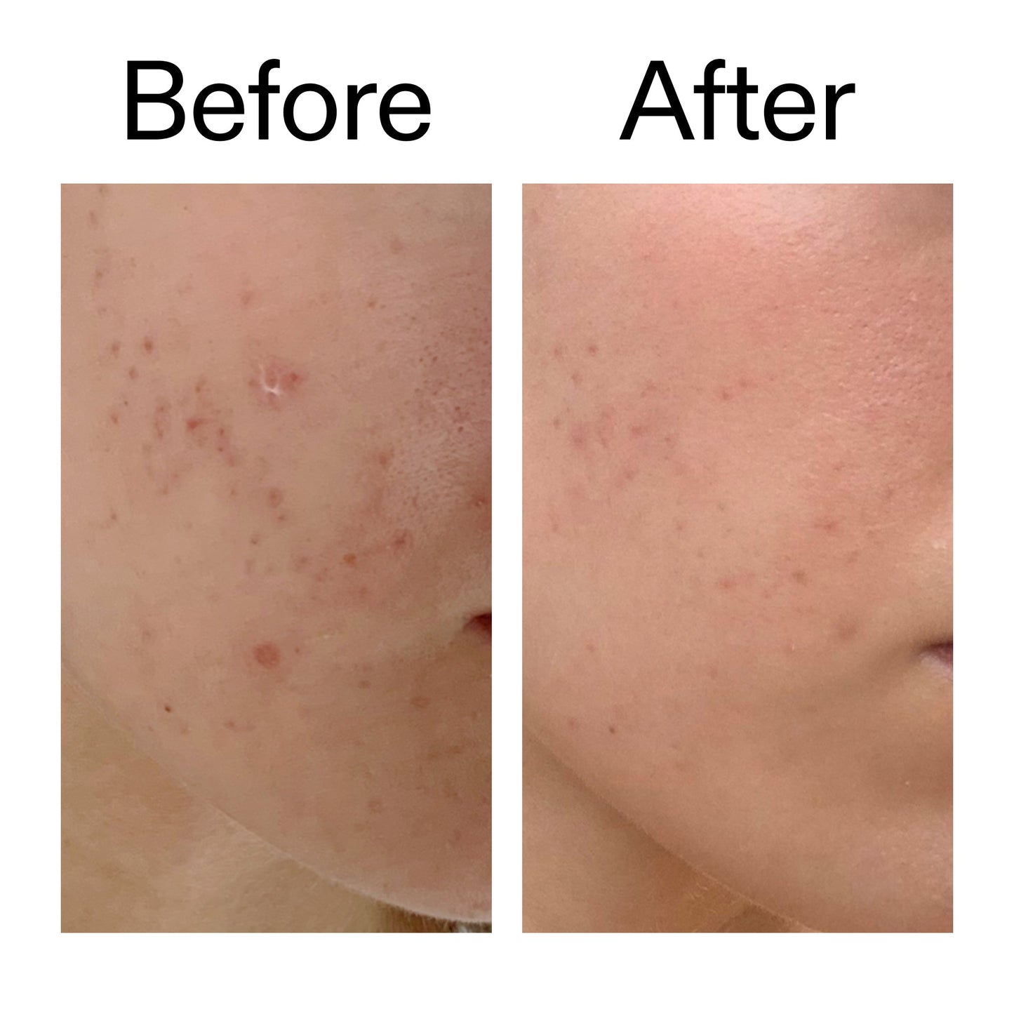 mandelic-acid-treatment-p2 Mandelic_Acid_Treatment_Before_After_2000x2000_4885ac6e-c5d7-4279-a72a-1417af7dce35.jpg