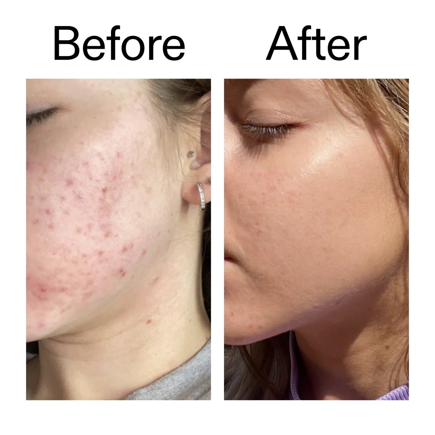 10-niacinamide-serum-u6 Niacinamide_Serum_Before_After_2000x2000_bde32455-9e7d-448e-b053-bef41504f0a9.jpg