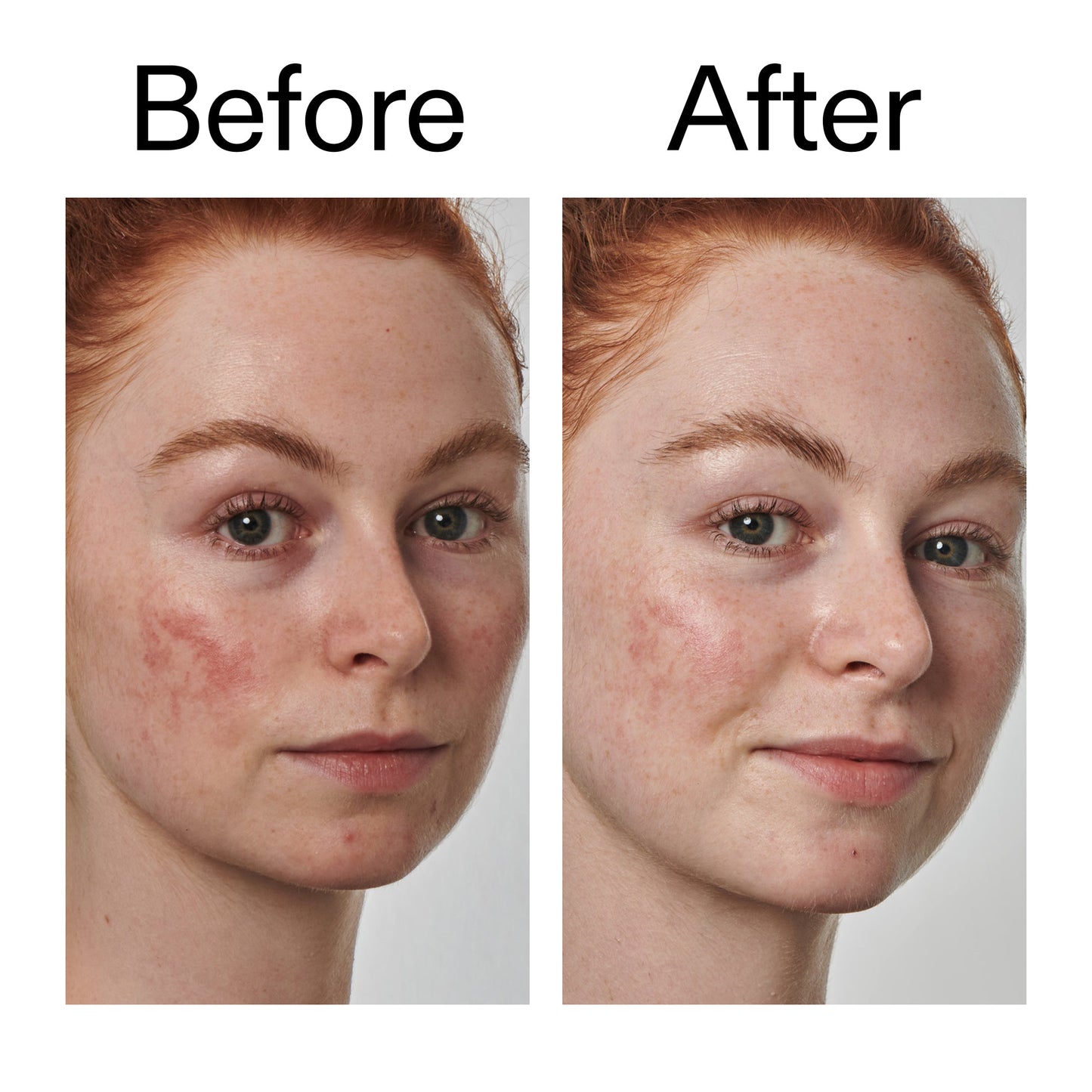 10-azelaic-acid-serum-for-redness-relief-l7 Redness_Relief_Serum_Before_After_2000x2000_3334dc9a-cce9-4e00-8aec-7ad89ca051f2.jpg