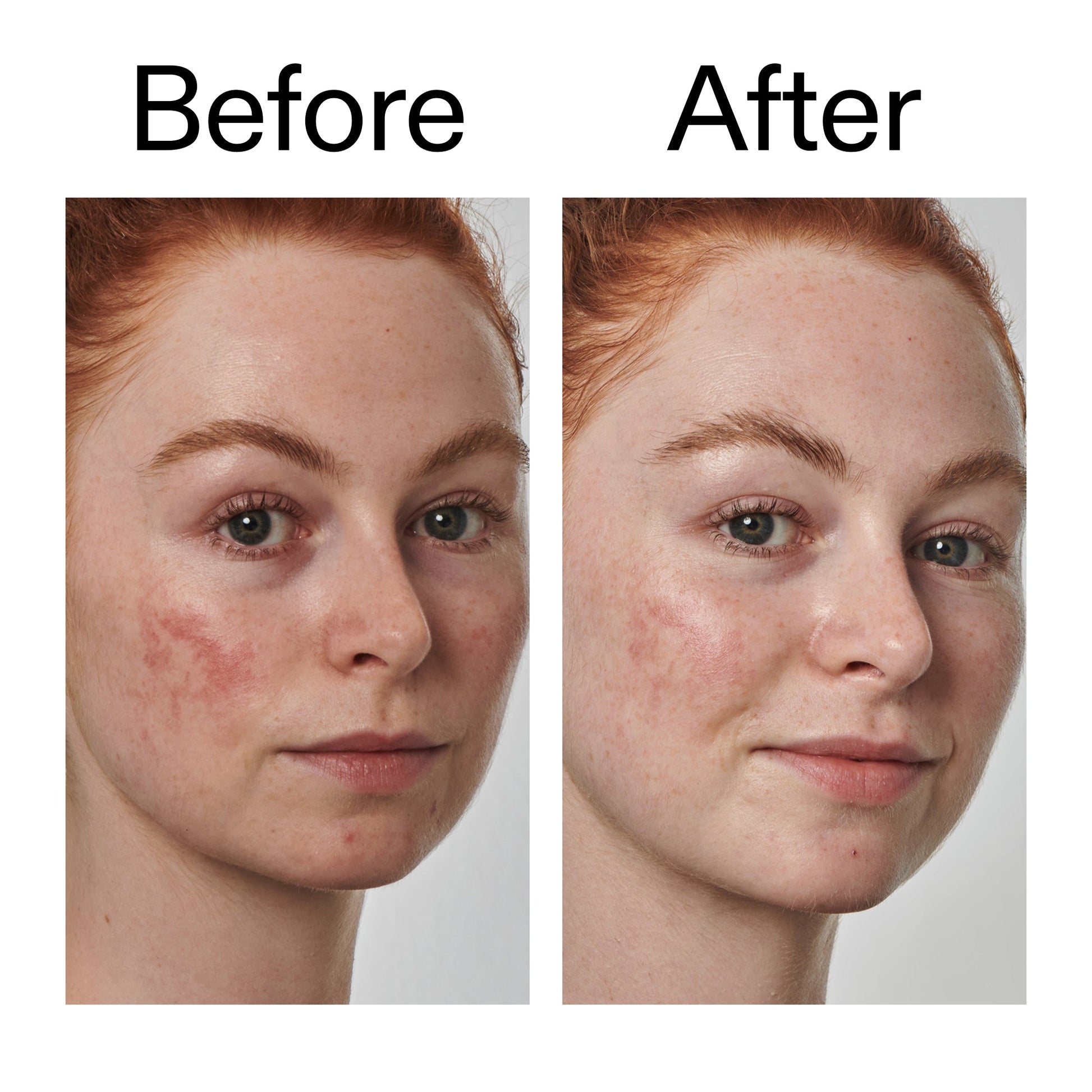 10-azelaic-acid-serum-for-redness-relief-l7 Redness_Relief_Serum_Before_After_2000x2000_3334dc9a-cce9-4e00-8aec-7ad89ca051f2.jpg