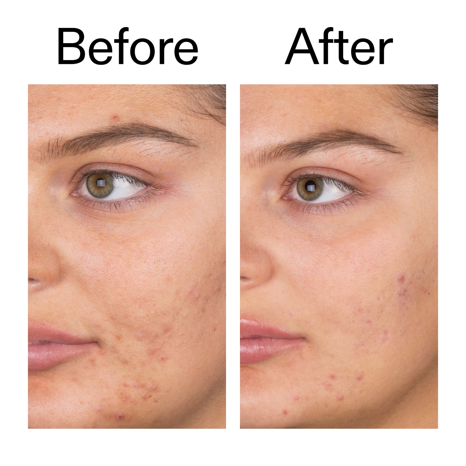 salicylic-acid-cleanser-duo-w2 Salicylic_Acid_Cleanser_-_150ml_Before_After_2000x2000_e7230494-853f-4b07-82b1-27669104c995.jpg