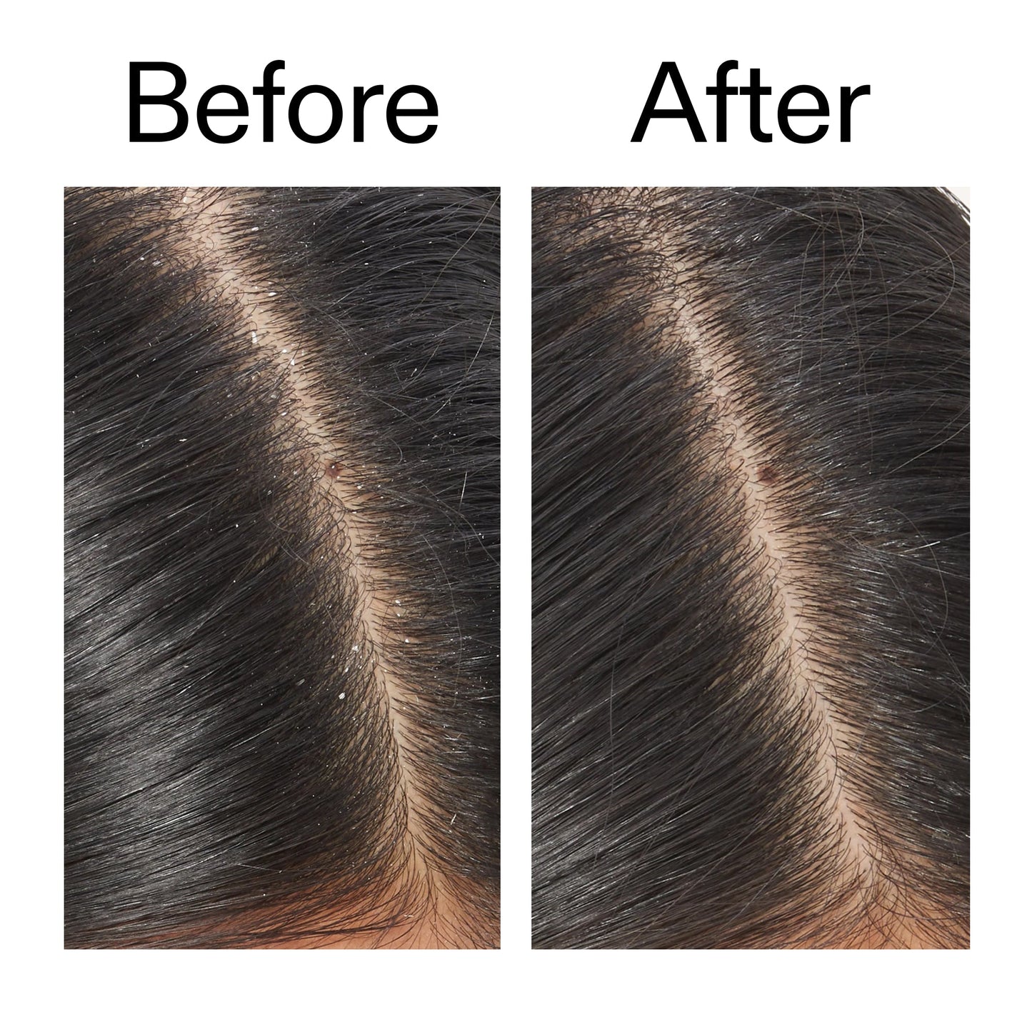 salicylic-acid-exfoliating-scalp-treatment-f2 Salicylic_Acid_Exfoliating_Scalp_Treatment_Before_After_V2_2000x2000_02bd61ad-42bf-490b-b3e3-7e04b2e8a673.jpg