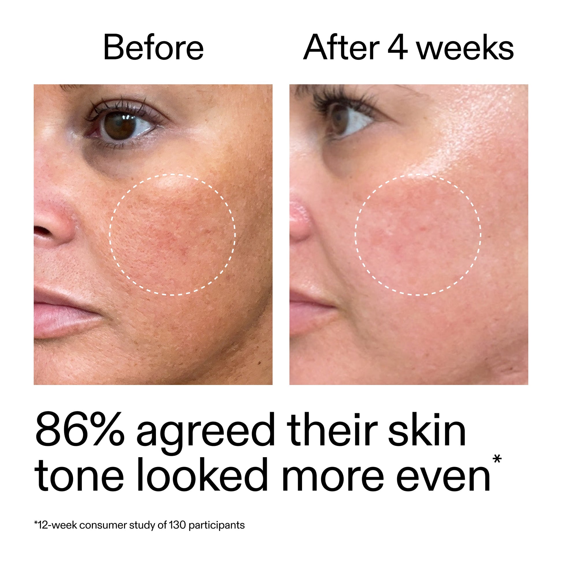 starter-retinol-serum-f4 StarterRetinol_BeforeAfter_Claim2_2000x2000_f5c9ecc0-8d76-429d-bef5-c3a61bcf5c09.jpg