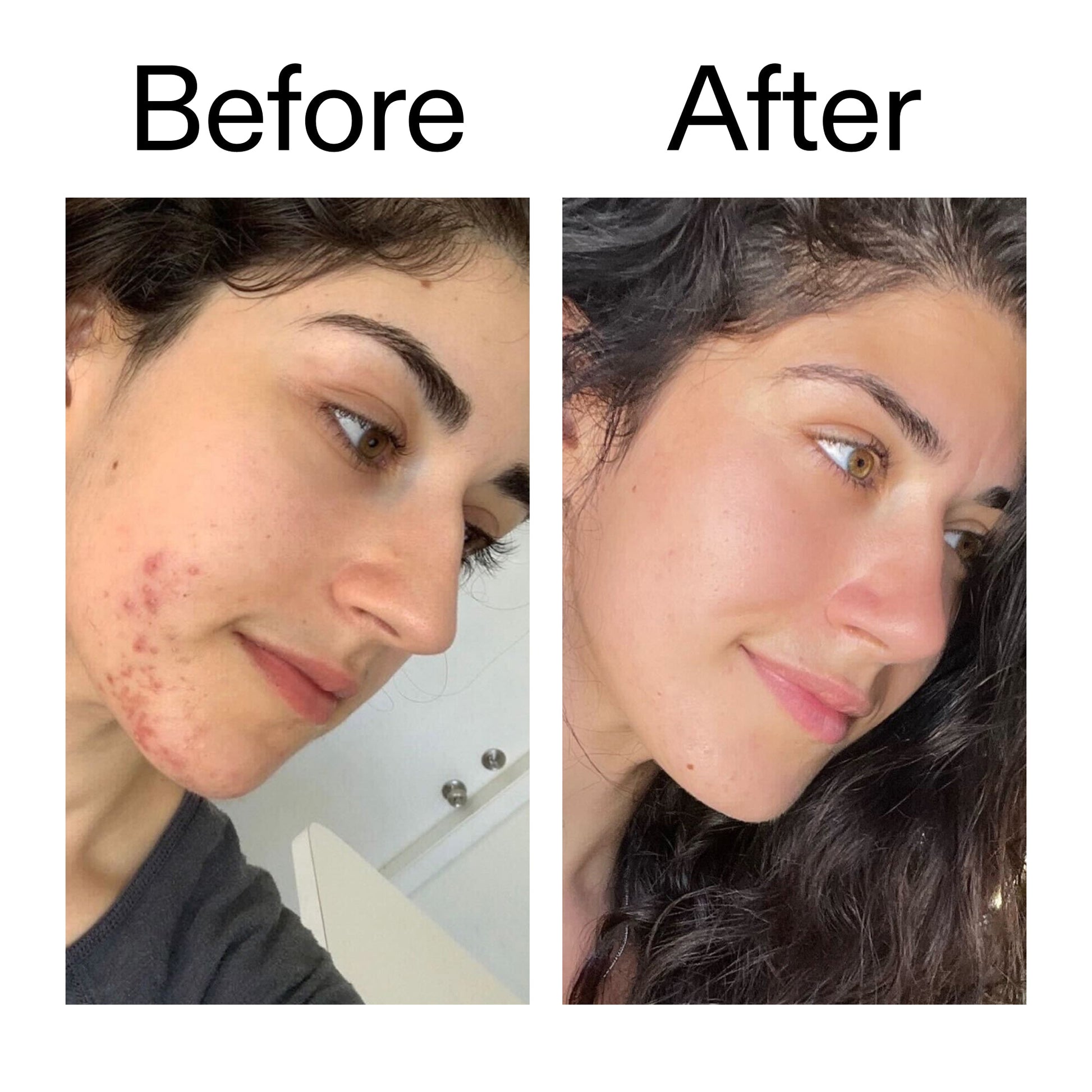 succinic-acid-acne-treatment-y0 Succinic_Acid_Treatment_Before_After_2000x2000_6a5f0054-2f58-4433-9314-0dc72c9bdd3b.jpg