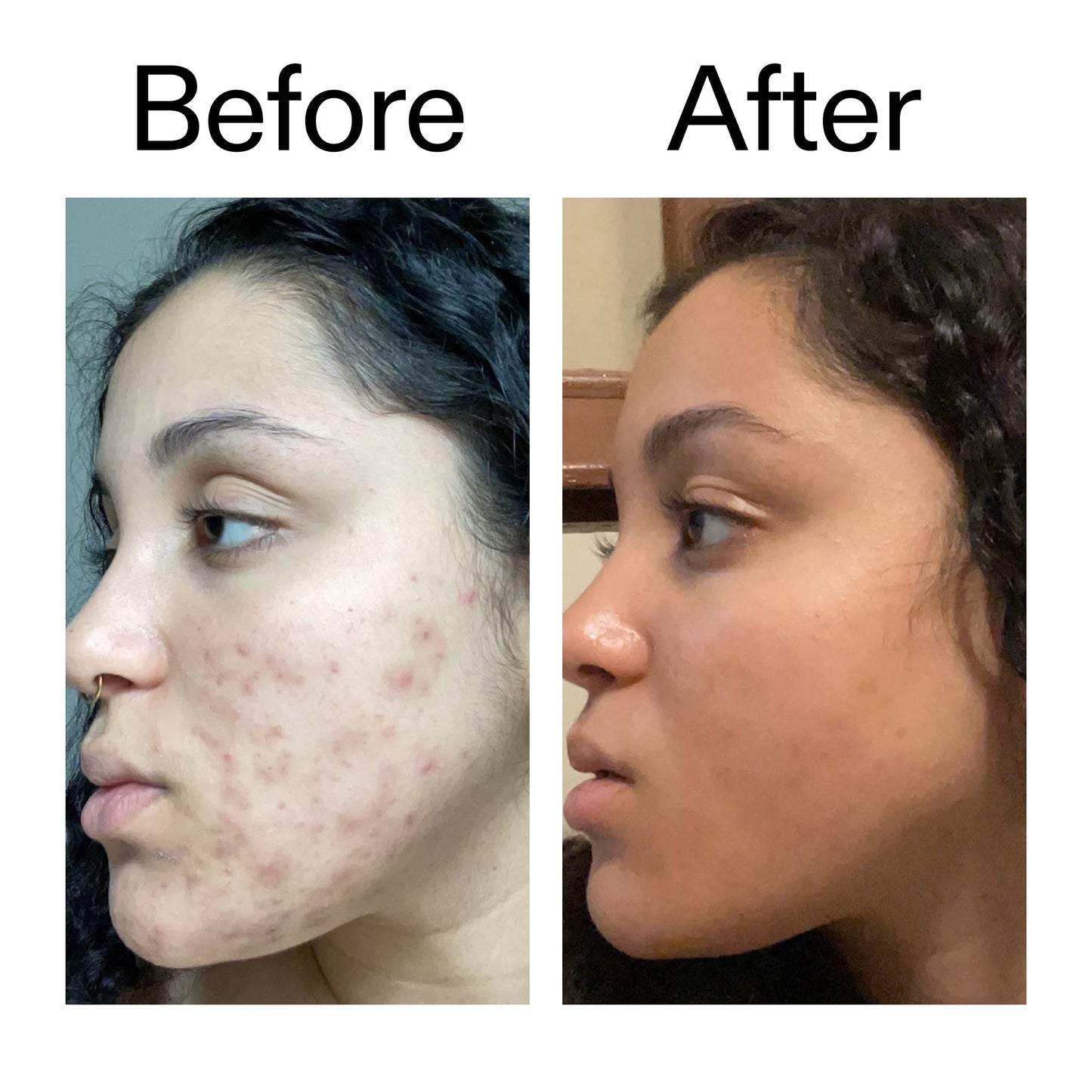 tranexamic-acid-serum-x0 Tranexamic_Acid_Serum_Before_After_2000x2000_98ebc8be-77b0-4843-8a22-90790ebe918b.jpg